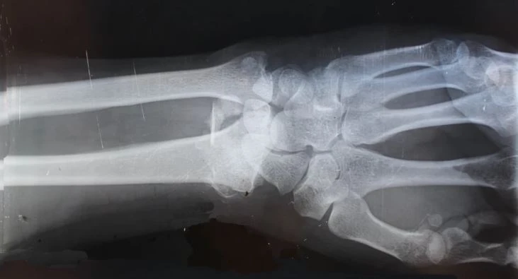 X-ray of wrist